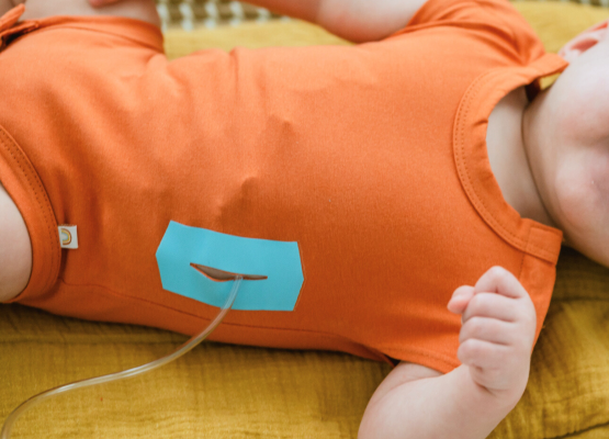 Baby in orange onesie with a turquoise opening for a stomach feeding tube