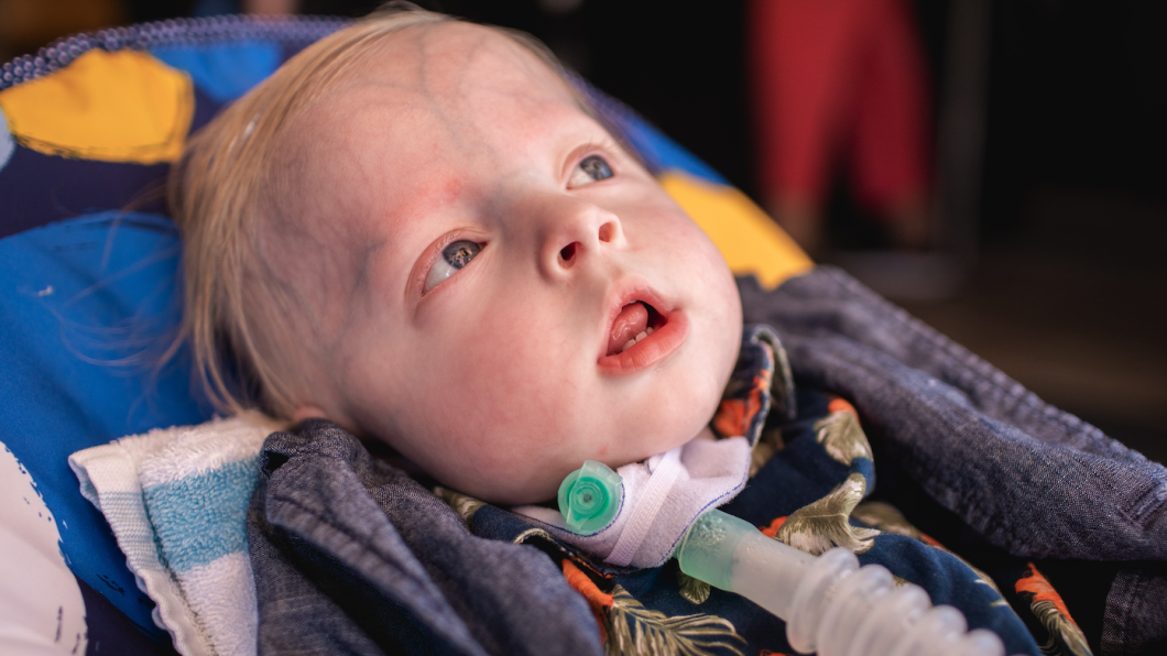 Young boy with tracheostomy tube lying in a chair facing upwards