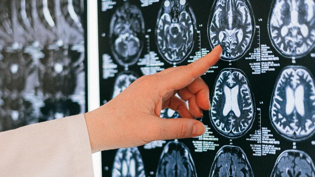 Image of brain scans being reviewed by health-care team member. Credit: Pexels.com Anna Shvets